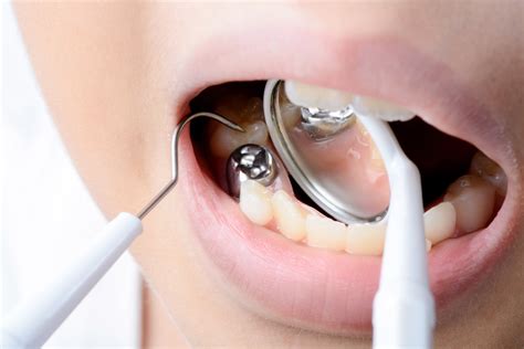 1. Harga Tambal Gigi di Puskesmas dengan BPJS