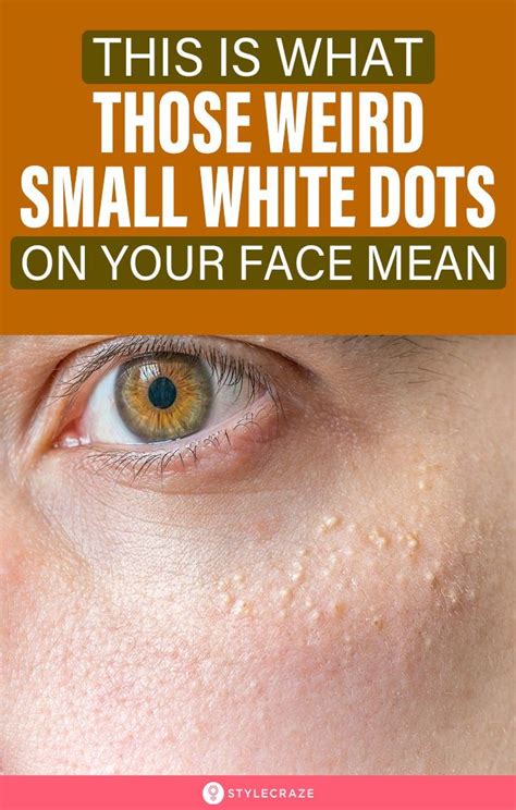 The Best 5 Small White Spots On Skin Pictures Doggerscoinpics
