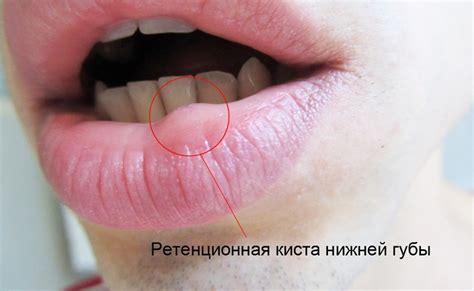 Kyste de rétention sur la lèvre: un danger caché en vous ...