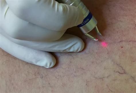 980nm Diode Laser Spider Vein Treatment Telangiectasia Removal