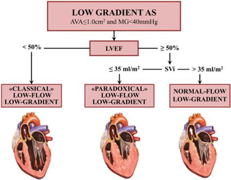 Low Flow Low Gradient Severe Aortic Stenosis Diagnosis And Treatment