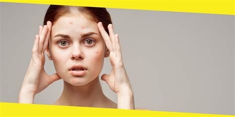 Learn About The Causes Types And Treatment Options Available For Acne