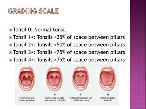Tonsillitis Grading Scale