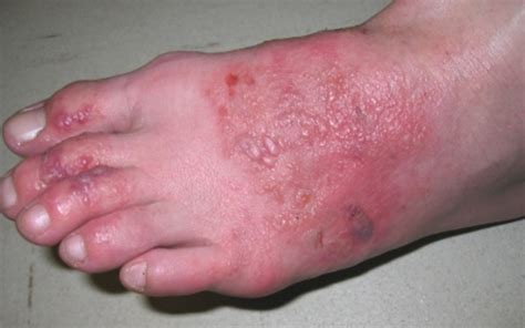 12 Causes Of Itchy Feets Hubpages