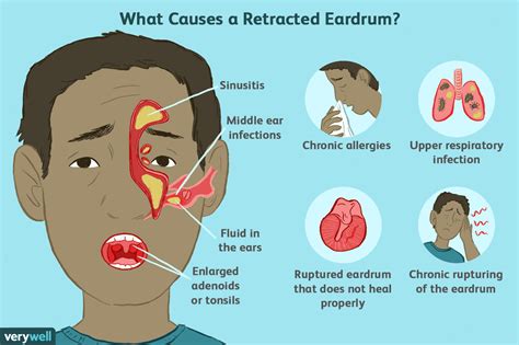 Retracted Ear Drum Causes Symptoms And Treatment