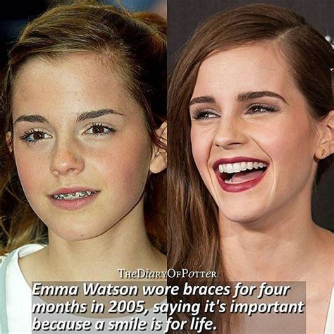 Have You Ever Wear Braces Credit Thediaryofpotter Regram Via