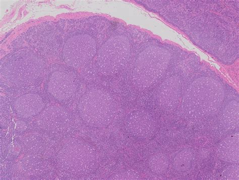 Reactive Lymph Node Conditions In Childhood Diagnostic Histopathology