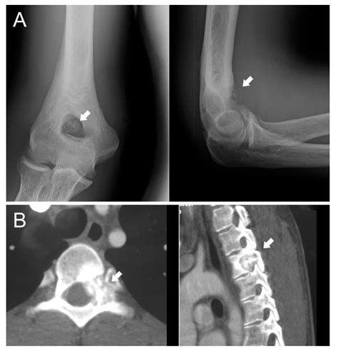 Jcm Free Full Text Osteoblastoma When The Treatment Is Not