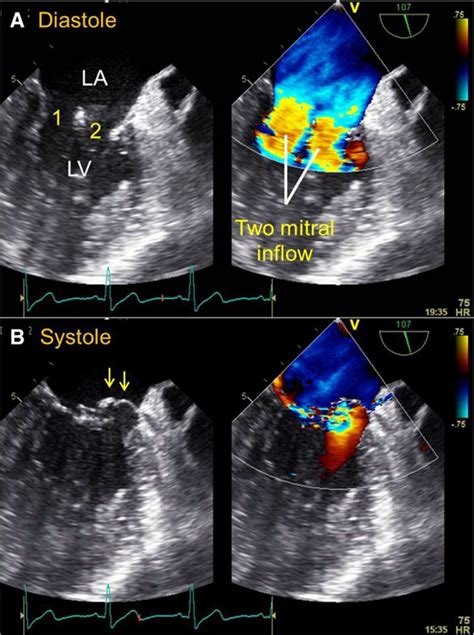 Three Dimensional Echocardiographic Reconstruction Of Double Orifice Mitral Valve And Mitral