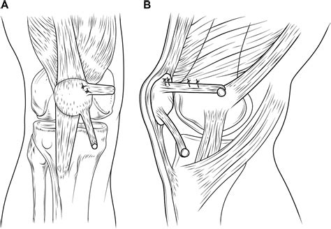 Combined Reconstruction Of The Medial Patellofemoral Ligament With