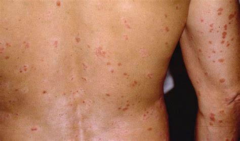 What Is Guttate Psoriasis Causes And Best Treatment Options