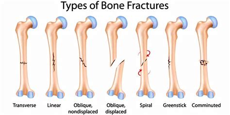 Backbone views don't contain html for our application, but the logic behind the presentation of the models. Long bone anatomy, structure, parts, function and fracture types