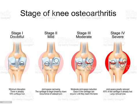 Stages Of Knee Osteoarthritis Stock Illustration Download Image Now