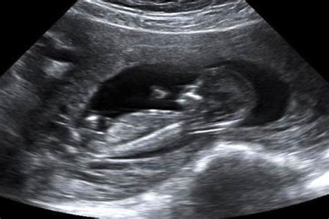 Como Se Mide El Peso Del Bebe En Una Ecografia - La importancia de la ecografía a las 11+0 a 13+6 semanas de embarazo