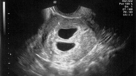 ultrasound at 4 weeks new health advisor