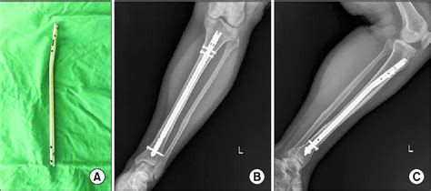 A This Photograph Demonstrates Cannulated Tibia Nail Ctn Synthes