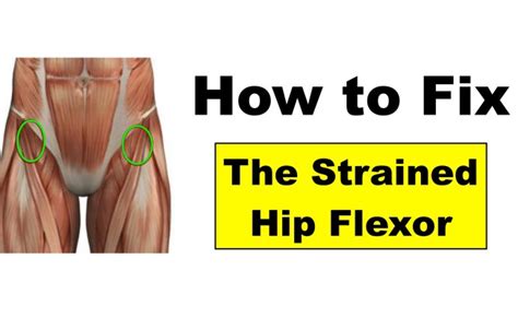 Hip Flexor Strain Symptoms And Treatment Bioskin Bracing Solutions