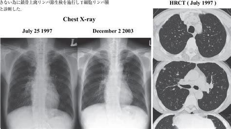 Pa Chest Radiograph And Ct Showed Mild Bilateral Hilar Lymph Node