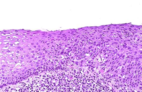 Female Genital Pathology