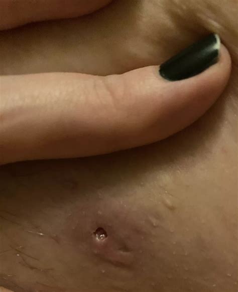Aftermath Of Staph Infection I Am On Antibiotics Nudes Popping Nude Pics Org