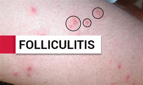 Folliculitis The Wellness Corner