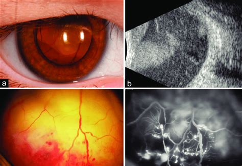 Stage 3b Coats Disease With A Massive Retinal Detachment Up To The