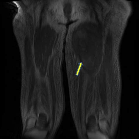 T2 Weighted Cross Sectional Mri Image Of The Left Thigh Showing Edema