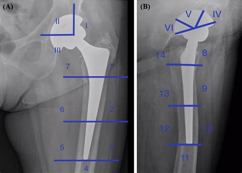 Uncemented Total Hip Arthroplasty In Patients Younger Than 20 Years