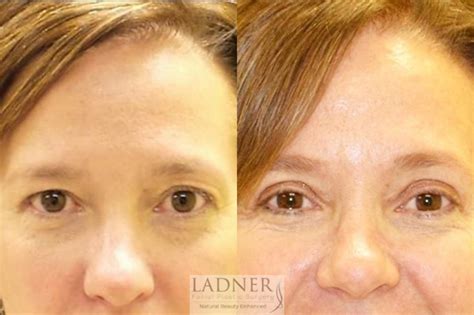 Eyelid Surgery Before And After Pictures Case 50 Denver Co Ladner