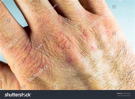 Close View Dry Cracked Hand Knuckles Stock Photo 793316842 Shutterstock