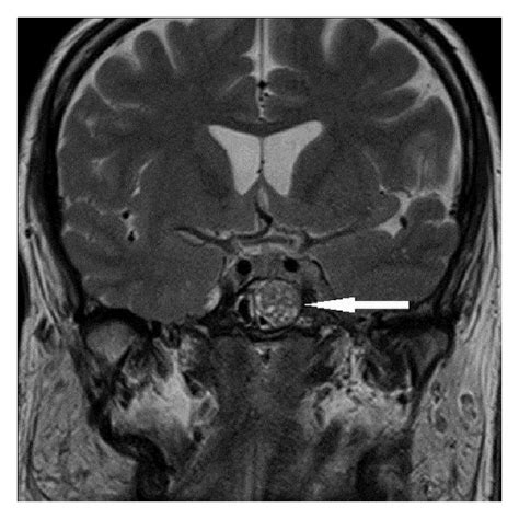 Mri Brain T2 Weighted Contrast And Coronal Showing A Pituitary