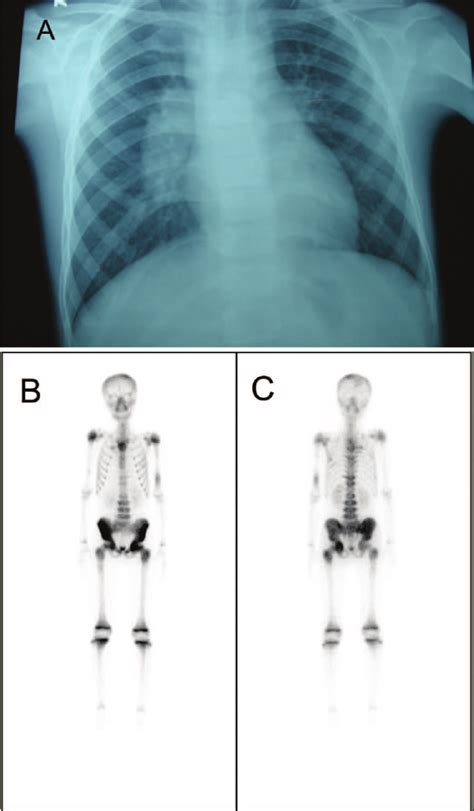 Chest X Ray Postero Anterior View Showing A Right Hilar And Upper