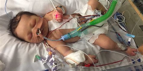 Brave Baby Survives Open Heart Surgery At 1 Week Old Fox News