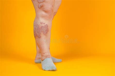 Dermatological Skin Disease Psoriasis Eczema Dermatitis Allergies