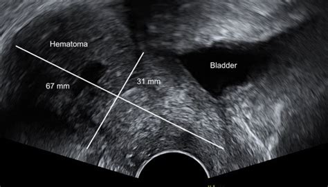 An Unusual Case Of Acute Complete Urinary Incontinence 20 Days After