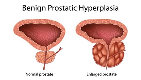 Benign Prostatic Hyperplasia Bph Dtap Clinic