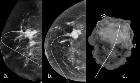 Wire Localization Mammograms A Mlo B Cc View That Show A Hawkins