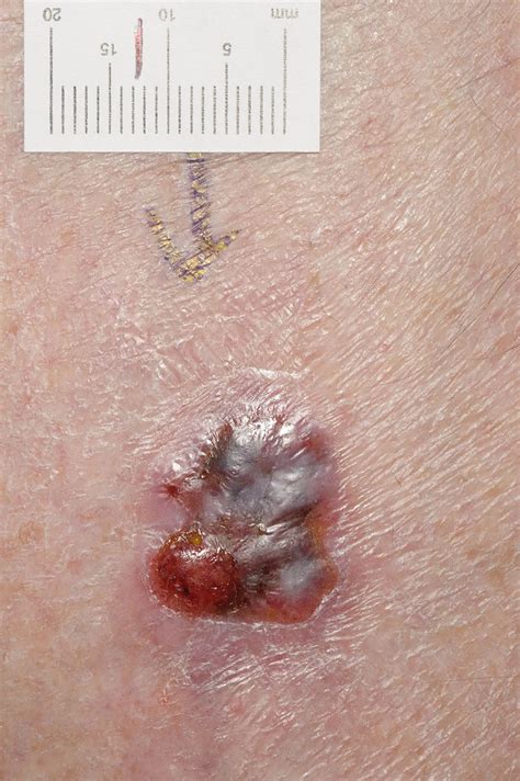 Amelanotic Melanoma The Bmj