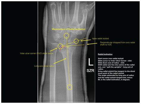 Improved Precision Of Radiographic Measurements For Distal Radius