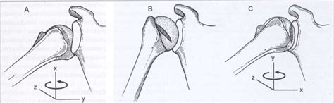 The Engaging Hill Sachs Lesion A This Impaction Fracture Is Created