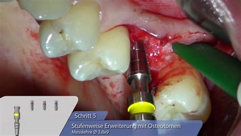 Ot F3 Implantat Insertion Mit Sinuslift Osteotomie Zwp Online Das