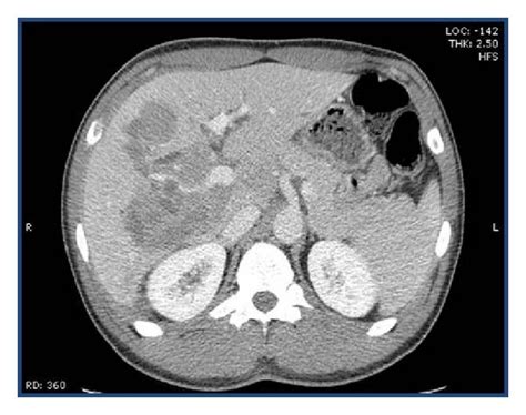Ct Scan With Intravenous Contrast Portal Venous Phase Showing Multiple
