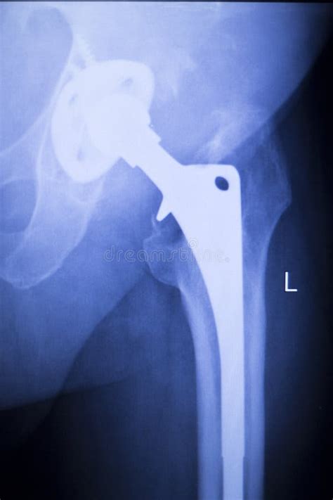 Hip Replacement Xray Orthopedic Medical Scan Stock Image Image Of