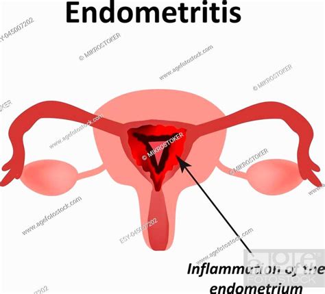 Endometritis Inflammation Uterus Royalty Free Vector Image Hot Sex