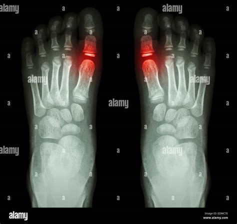 Rheumatoid Arthritis Gouty Arthritis X Ray Childs Foots And