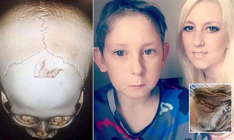 Mother Releases Scan Of A Huge Fracture In Her Son S Skull My