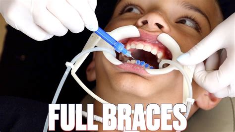 Getting Braces For The First Time For The Second Time Top And Bottom Braces Put On Again Youtube