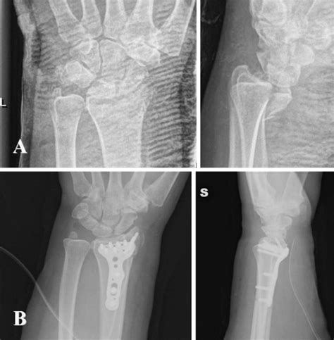 Management Of Distal Radius Fractures Treatment Protocol And