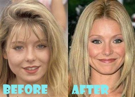 Kelly Ripa Botox Plastic Surgery Botox Before And After Botox