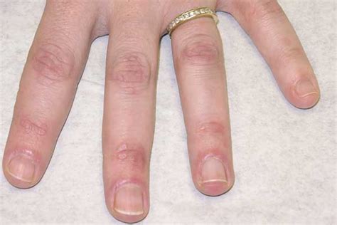 Clinical Challenge Red Lesions On The Interphalangeal Joints Of The